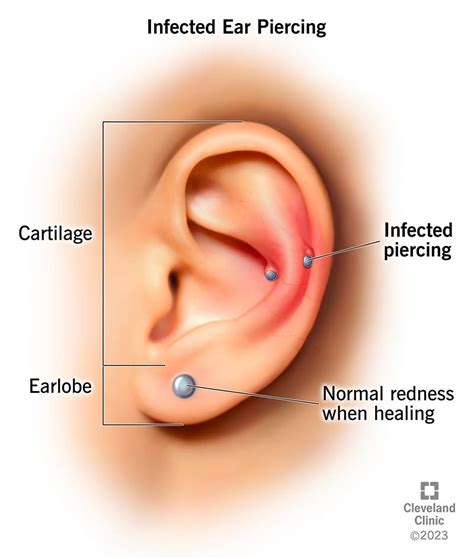 console whether Unthinkable allergic reaction to earrings treatment ...