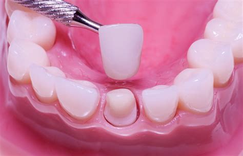 Dental Crowns: types, cost private & NHS, before and after