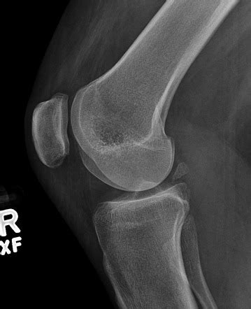 Knee (lateral view) | Radiology Reference Article | Radiopaedia.org