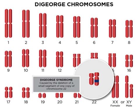 DiGeorge Syndrome Diagnosis & Treatment | Cardinal Glennon