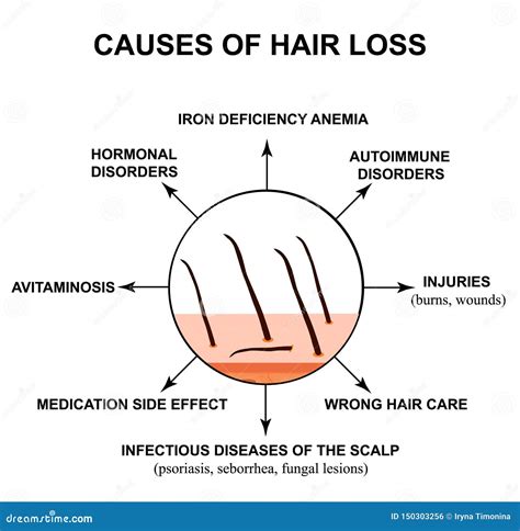 Causes of Hair Loss. the Structure of the Skin and Hair. Infographics ...