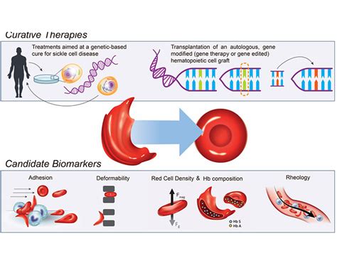 Reaching toward a cure for sickle cell disease