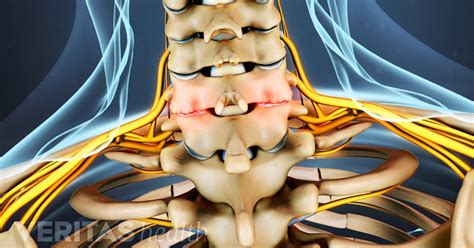 Cervical Facet Osteoarthritis Video