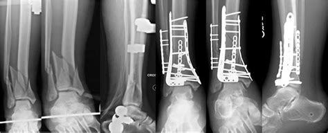 A complete articular tibial plafond fracture managed using staged ...