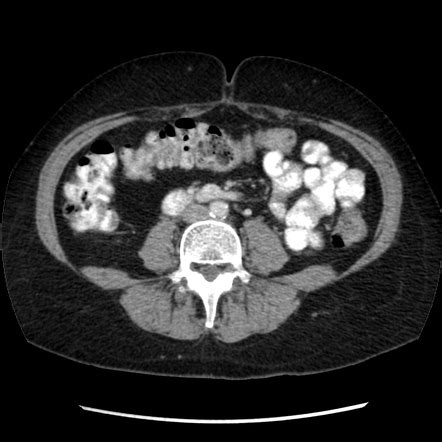 Why Ct Scan Abdomen Pelvis