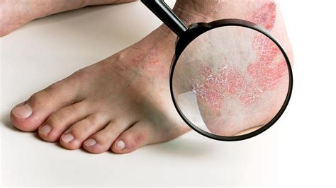 Psoriasis on Your Feet | Psoriasis | Everyday Health