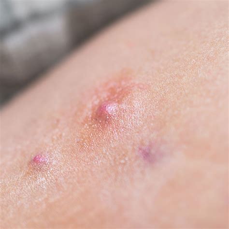 Hidradenitis Suppurativa Thigh Treatment