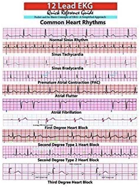 Ekg Examples Of Interpretation Cardiac Nursing Icu Nursing Ekg ...