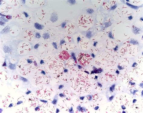 Mycobacterium Tuberculosis Morphology Characteristics Acid Fast Stain ...