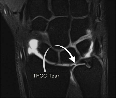 Tfcc Tear Mri - Goimages Inc