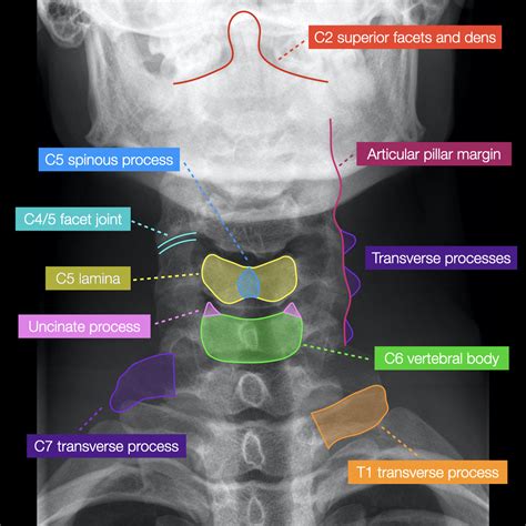 Normal Radiographic Anatomy Of The Cervical Spine Neurology Medical ...