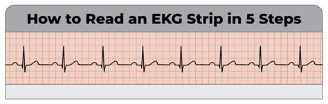 Ekg Rhythm Strips