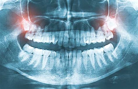 Common Signs to Get Wisdom Teeth Removed | Absolute Dental