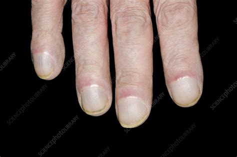 Clubbed fingernails - Stock Image - C014/8020 - Science Photo Library