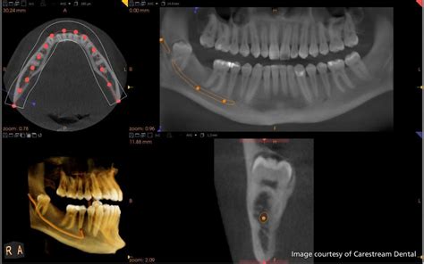 3D X-Ray/CT Scan Vancouver BC - Vancouver Dental Specialty Clinic