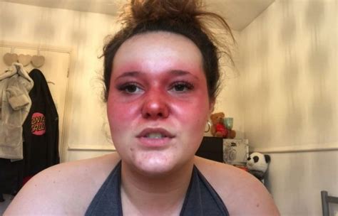 Teenager with lupus rash on her face shows off her 90 minute beauty ...