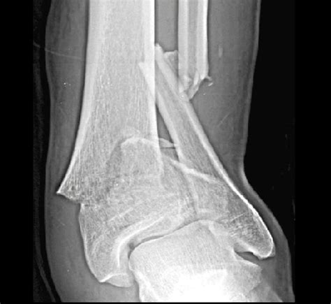 Tibial Plafond Fractures - Trauma - Orthobullets