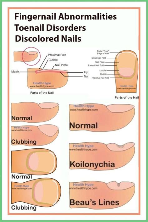 #NailPolishTipsAndTricks #Abnormalities, #Toenail Fingernail ...