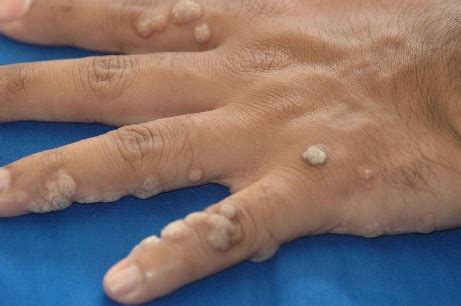 Viral Warts: Causes, Treatment and Home Remedy – Vitamin Resource