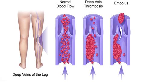 What is Deep Vein Thrombosis? | American Venous Forum