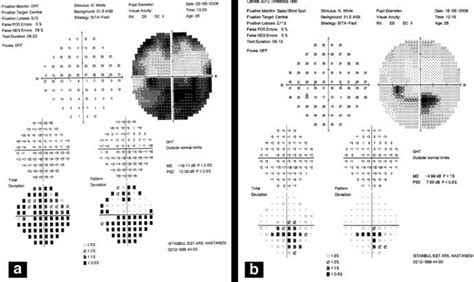 [PDF] Idiopathic Isolated Cilioretinal Artery Occlusion Treated with ...