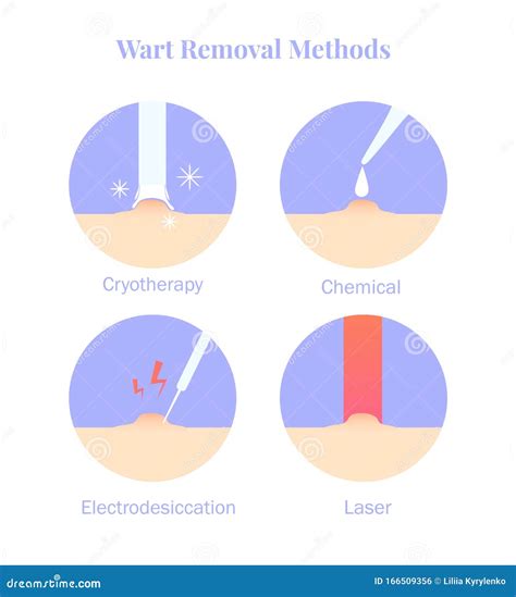 Infographics Wart Removal Methods. Cryotherapy, Electrodesiccation ...