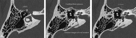 Retrospective Review of Otic Capsule Contour and Thickness in Patients ...