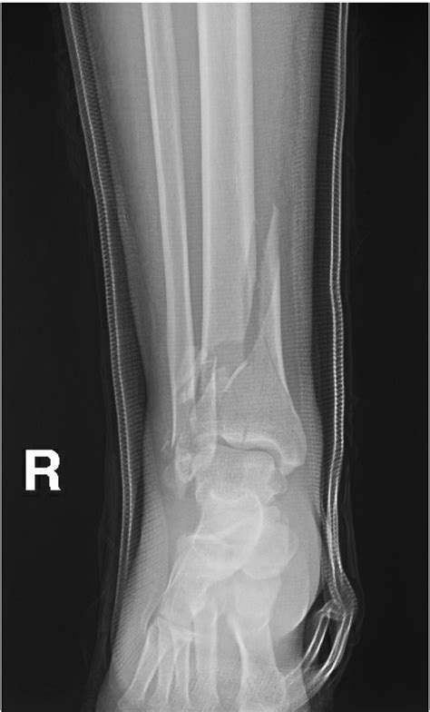 Ortho Pearls: Tibial Plafond Fracture — Cook County Emergency Medicine ...