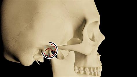 TMJ Dislocation Syndrome - YouTube