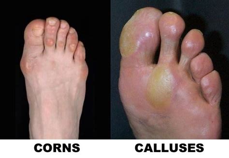 Calluses Archives - Dr7 Physiotherapy Podiatry Hydrotherapy Massage