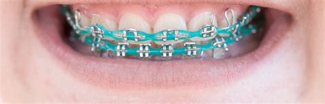 Is Teal a Good Color for Braces? - The Braces Guide