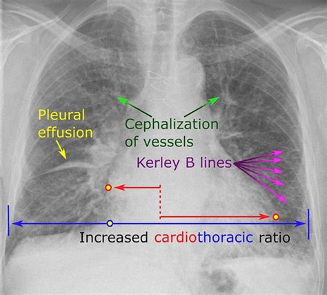 Chest X-ray of congestive heart failure [14] | Download Scientific Diagram