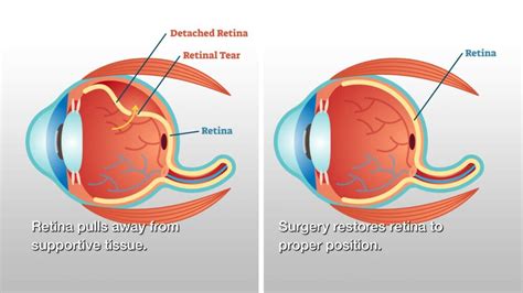 Retina Treatment Cost | Retina Treatment Cost in Delhi - EyeMantra