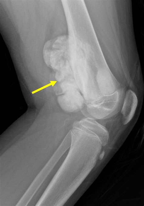 Parosteal osteosarcoma – Radiology Cases