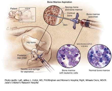 Bone Marrow Biopsy | Kansas City Accident Injury Attorneys