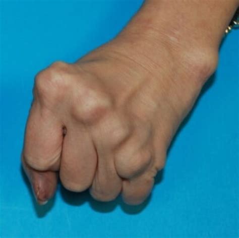 Deformities of the Hand | Hand Surgery Associates