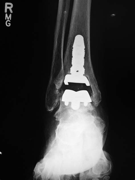 Joint Arthroplasty: a gallery