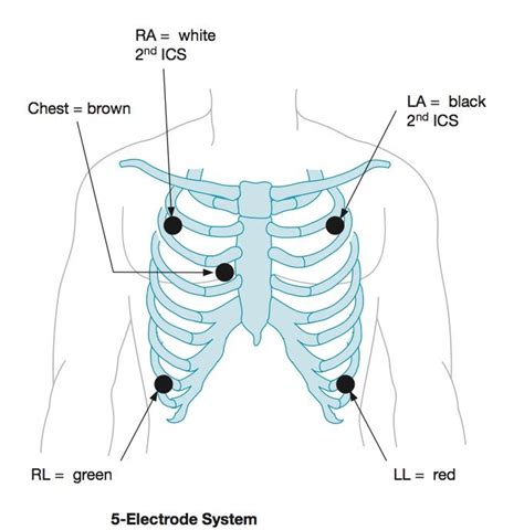 Cardiac Monitor Lead Placement - HeathrtHayes