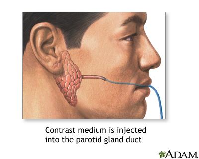 Sialography: MedlinePlus Medical Encyclopedia Image