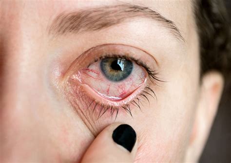 Eye Inflammation: Causes, Symptoms, and Treatment