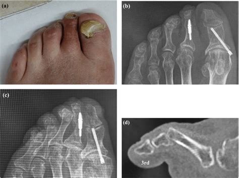 Clinical photograph showing callus formation over the third and fourth ...