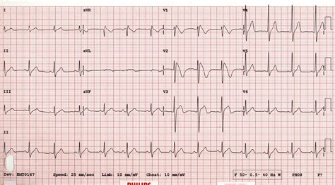 12 lead ECG for children and adults – SujyotHeartClinic