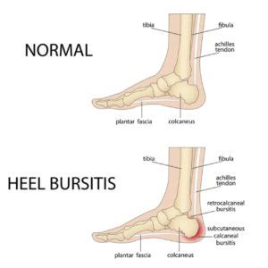 Tulang Pergelangan Kaki: Ligamen, Fungsi, Cedera, dan Perawatan ...