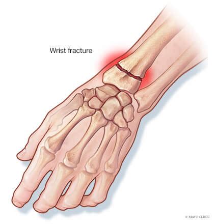 Hand & wrist fractures - Overview - Mayo Clinic Orthopedics & Sports ...