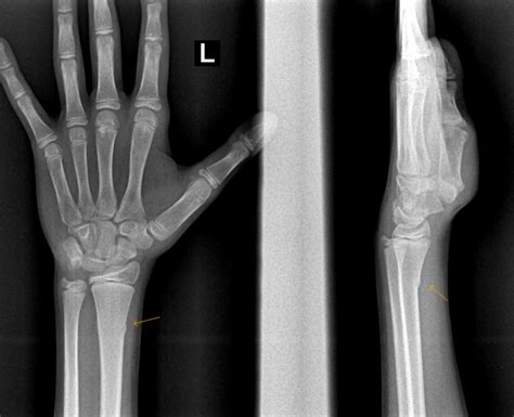 Torus Fracture-Radius - Sumer's Radiology Blog