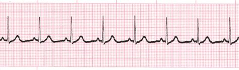 Normal Sinus Rhythm training - video | ProCPR