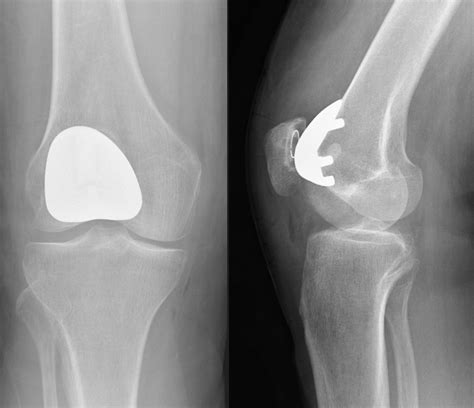 What is Knee Replacement? - Types , What to Expect & Cost of Surgery