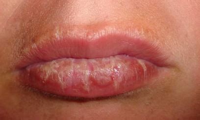 16 DIY Ways to Treat Sunburned Lips Easily Using Some Home Remedies ...