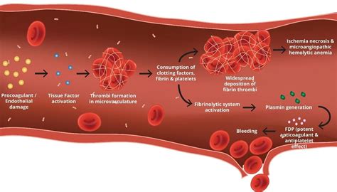 Disseminated Intravascular Coagulation (DIC): An Overview