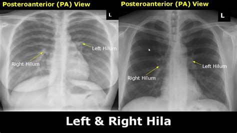 Anatomy Of Chest X Ray